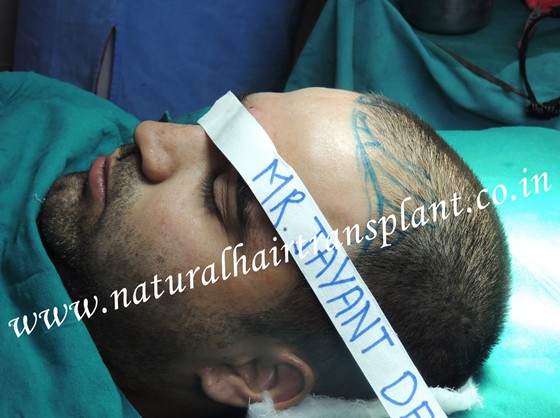Special offer for Hair Transplant of FUE & FUHT in Delhi, Pune: Stop Hair Loss to Cure Baldness Problem 
