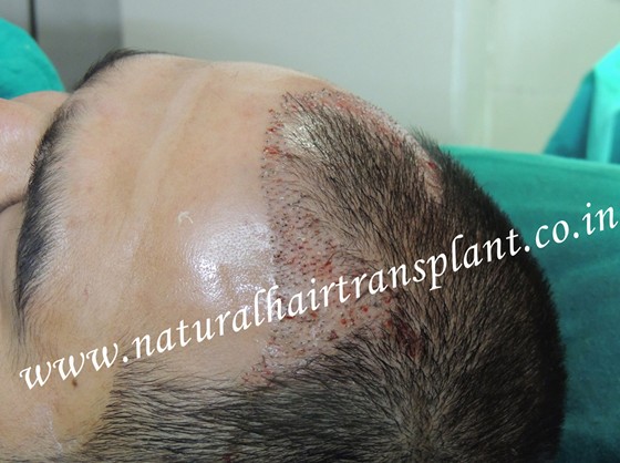 Special offer for Hair Transplant of FUE & FUHT in Delhi, Pune: Stop Hair Loss to Cure Baldness Problem 