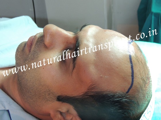 Special offer for Hair Transplant of FUE & FUHT in Delhi, Pune: Stop Hair Loss to Cure Baldness Problem 